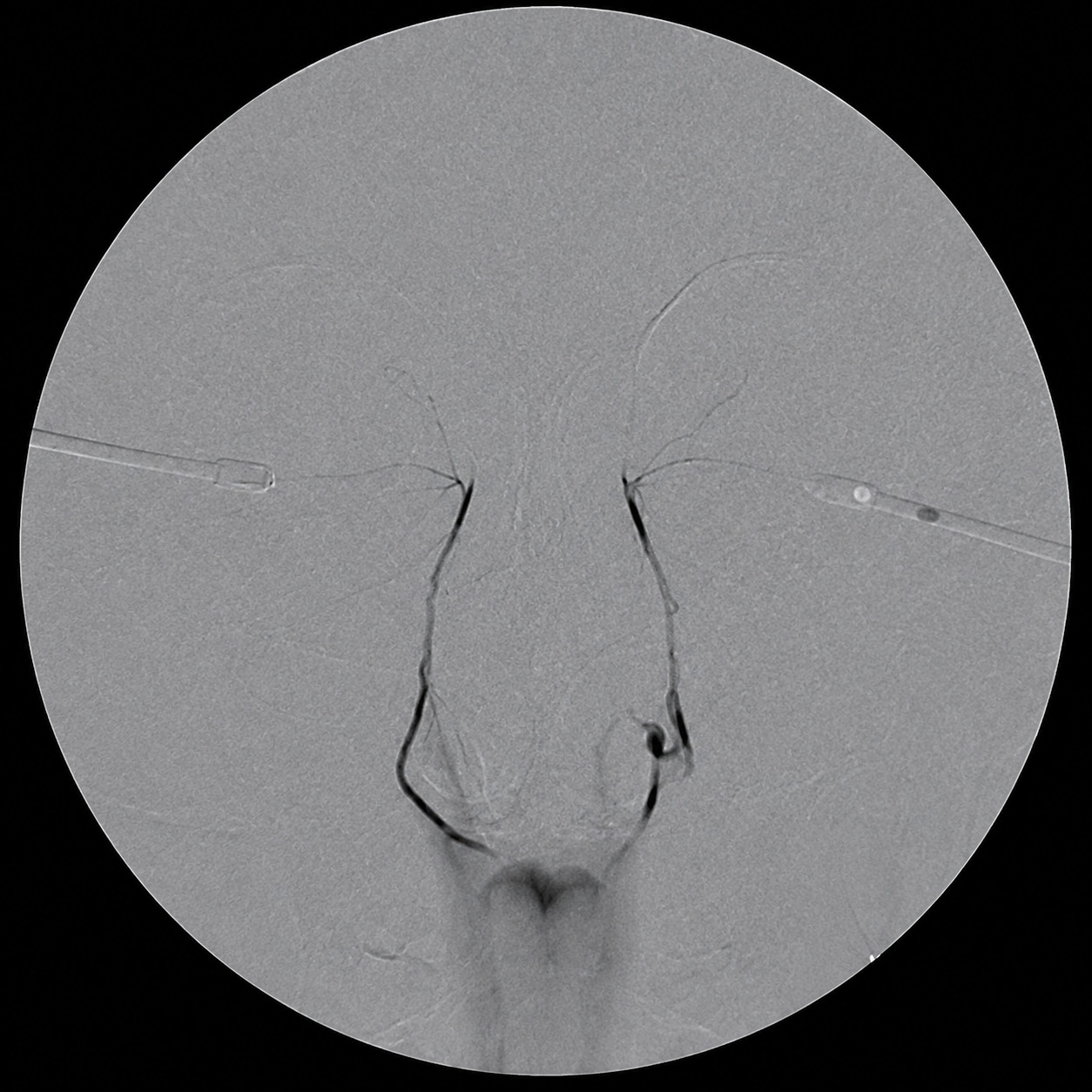 눈물흘림 C-arm 눈물길 X-RAY촬영 누낭조영술 DCG 2번 C-arm엑스레이