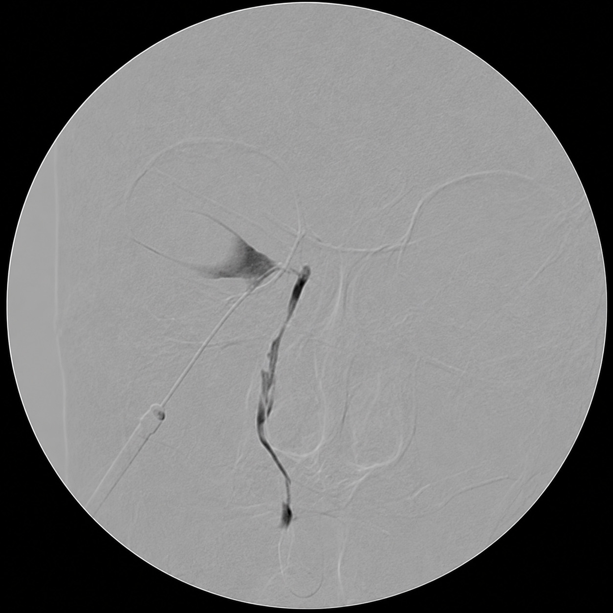 눈물흘림 C-arm 눈물길 X-RAY촬영 누낭조영술 DCG 3번 C-arm엑스레이