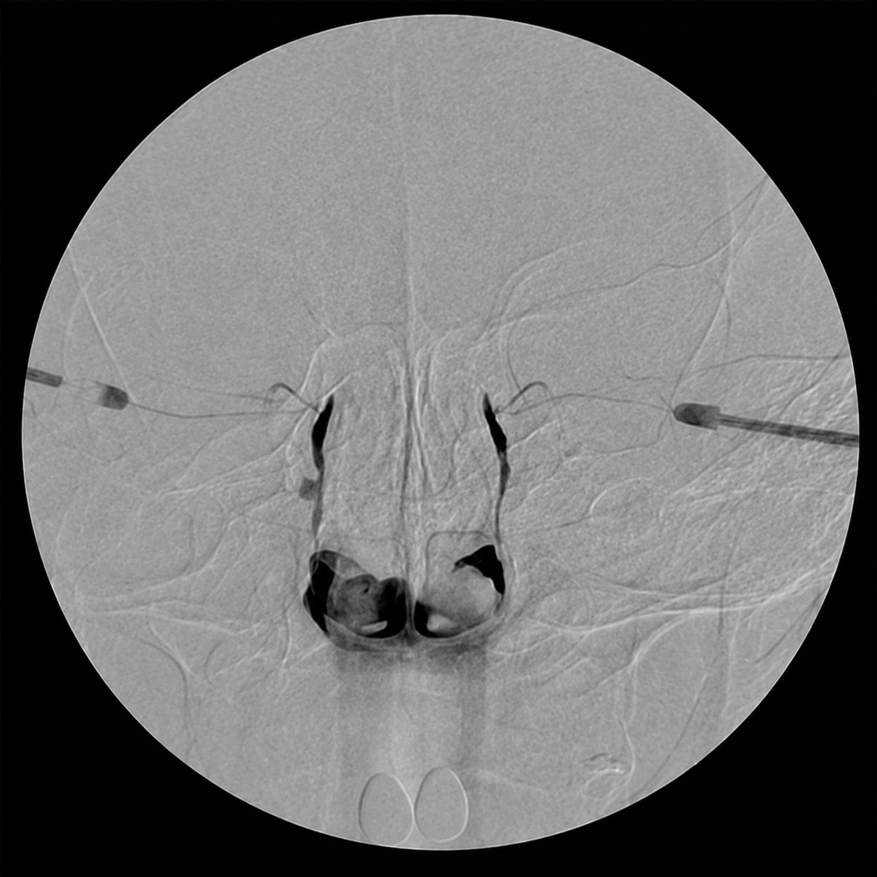 눈물흘림 C-arm 눈물길 X-RAY촬영 누낭조영술 DCG 1번 C-arm엑스레이
