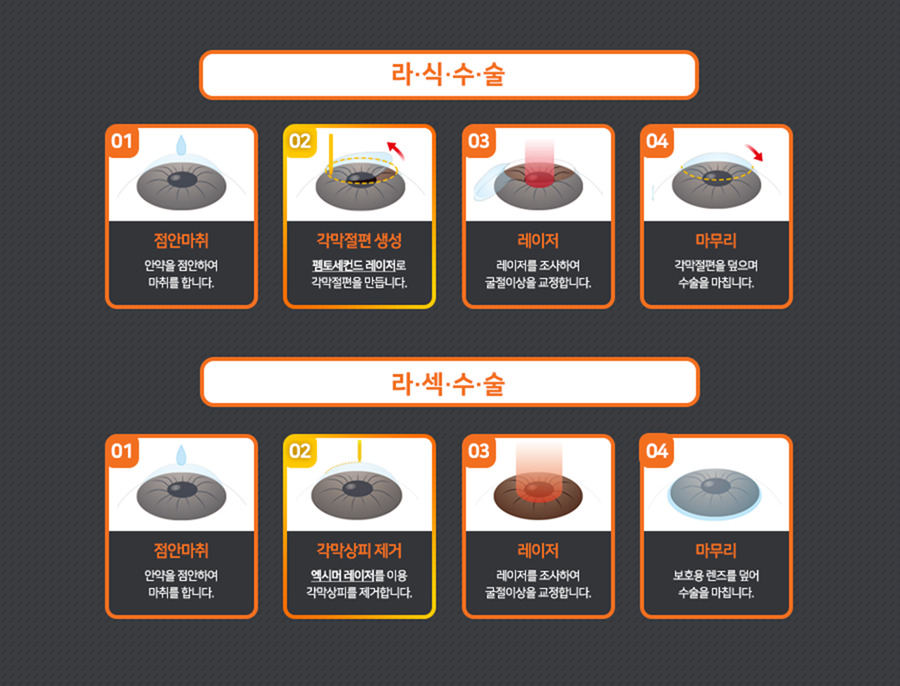 라섹 수술과정