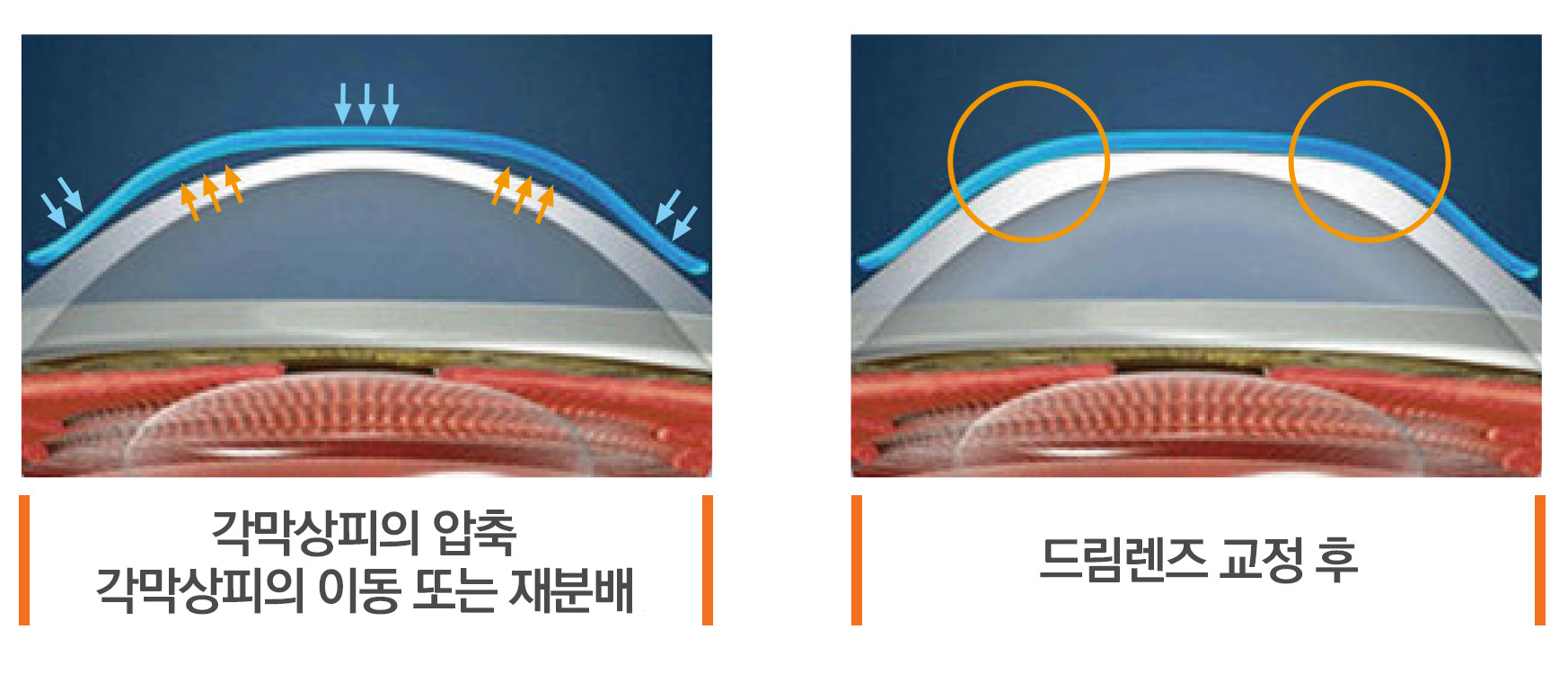 각막교정비교