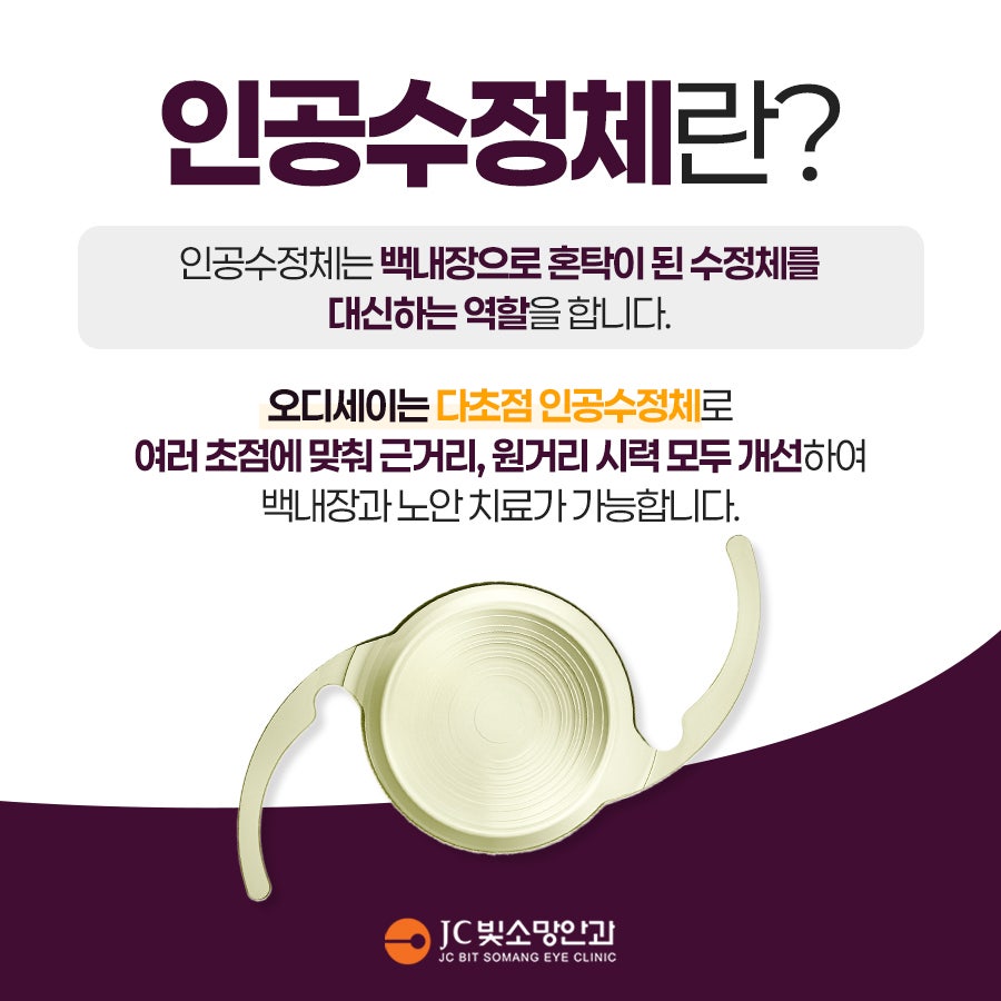 인공수정체정의