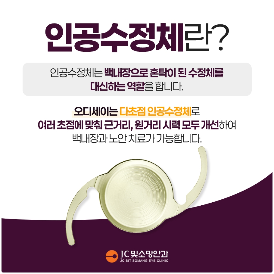 인공수정체정의