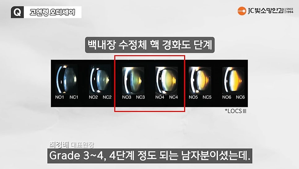ICL은 평생 유지될까, 여의도시력교정 후 백내장 생기면 어떻게 되나