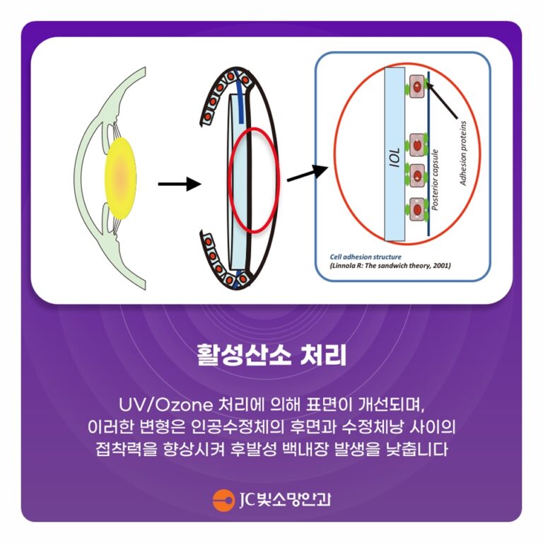 초고도근시 안축장 긴 눈의 여의도 백내장 수술, 인공수정체 선택이 어려운 이유