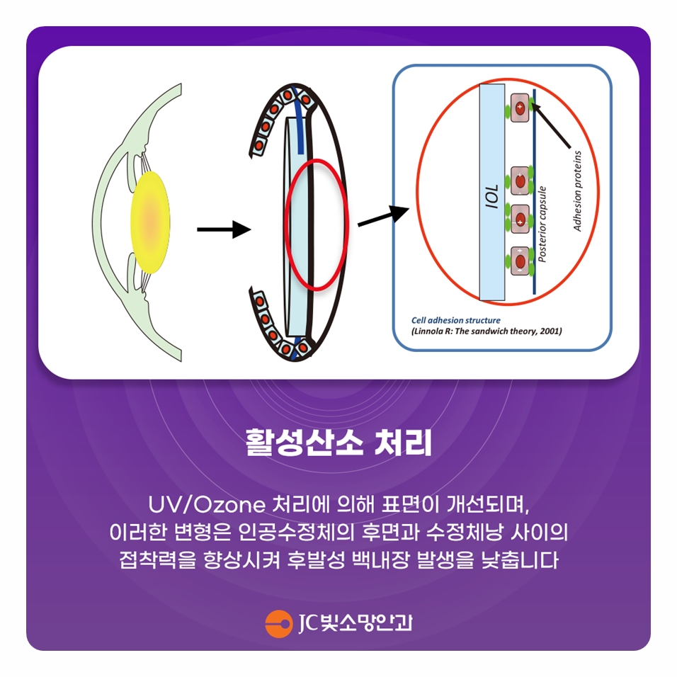 초고도근시 안축장 긴 눈의 여의도 백내장 수술, 인공수정체 선택이 어려운 이유