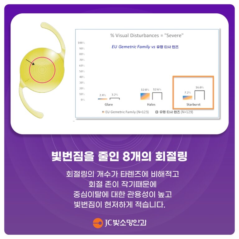 초고도근시인데 백내장 수술이 보류됐다면: 망막 평가에서 무엇을 확인할까