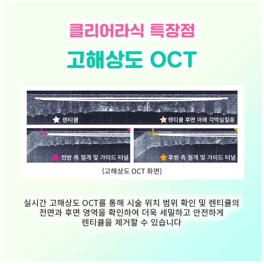 여의도라섹, 각막 표면만 벗겨낸다는 말은 정확히 무슨 뜻일까