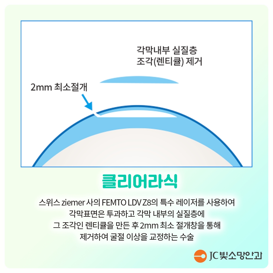 여의도 녹내장 안약, 평생 넣어야 할까 — 레이저(SLT)로 바꿀 수 있는 경우
