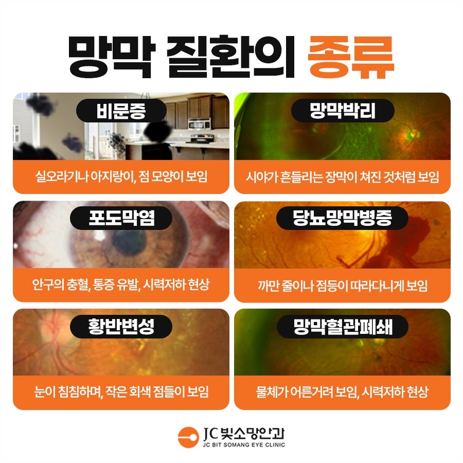갑상선 항진증으로 눈이 튀어나온다면, 영등포 안과가 보는 갑상선안병증 안구 관리