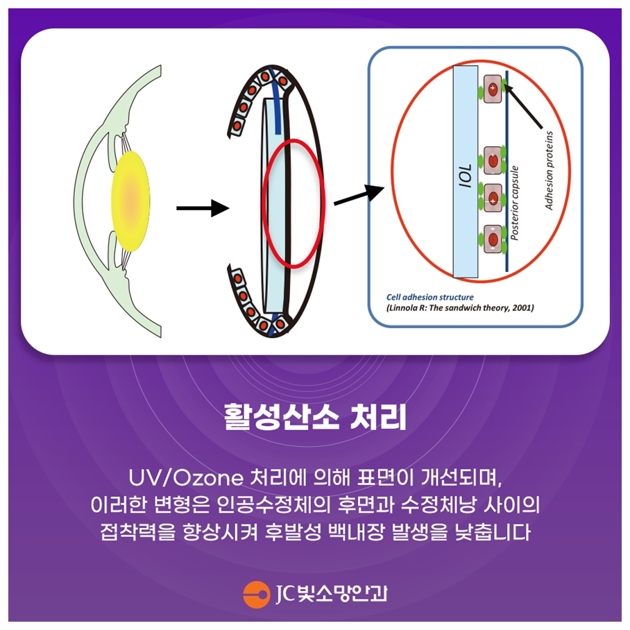 여의도 녹내장 안약, 평생 넣어야 할까 — 레이저(SLT)로 바꿀 수 있는 경우