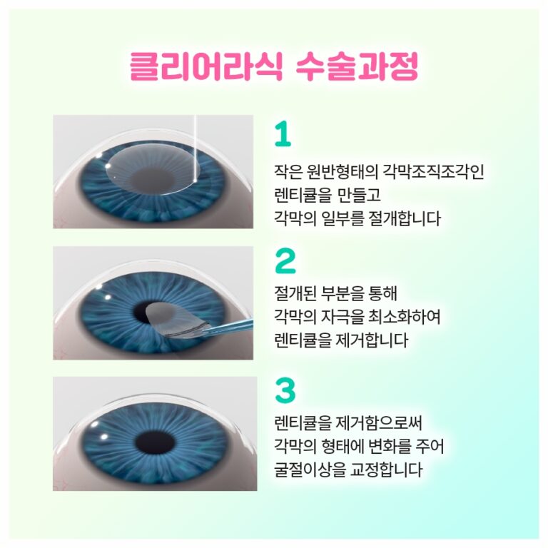 백내장 수술 후 시력 회복 기간은? 단계별 정리