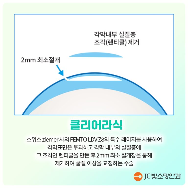 사물이 휘어 보일 때, 여의도망막 앞막(황반전막) 증상과 수술 시기