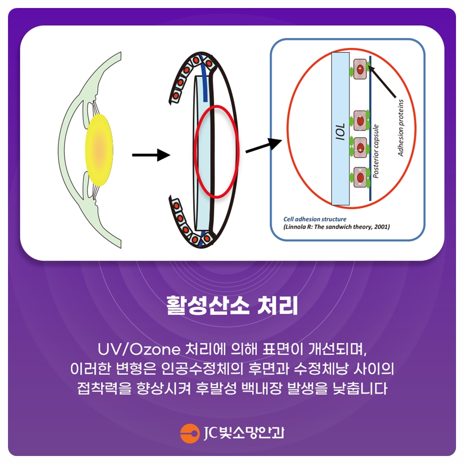 여의도소아안과 근시억제 렌즈 비교 — 마이오스마트·스텔리스트·마이오케어