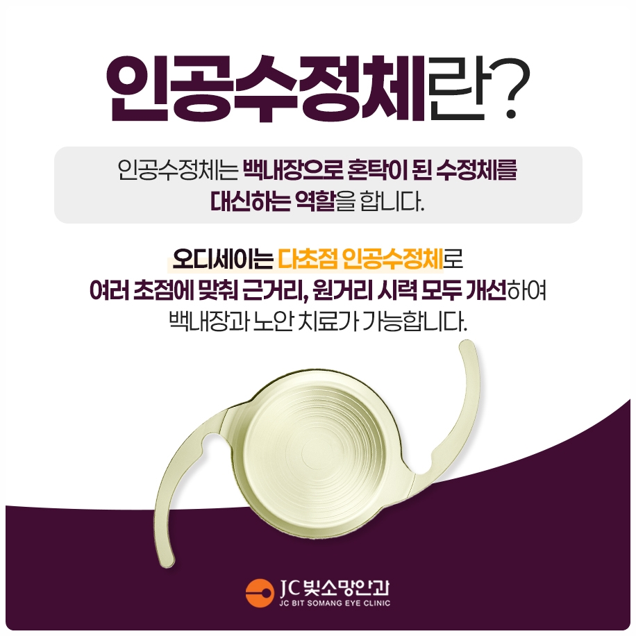 백내장 수술, 언제 할까?